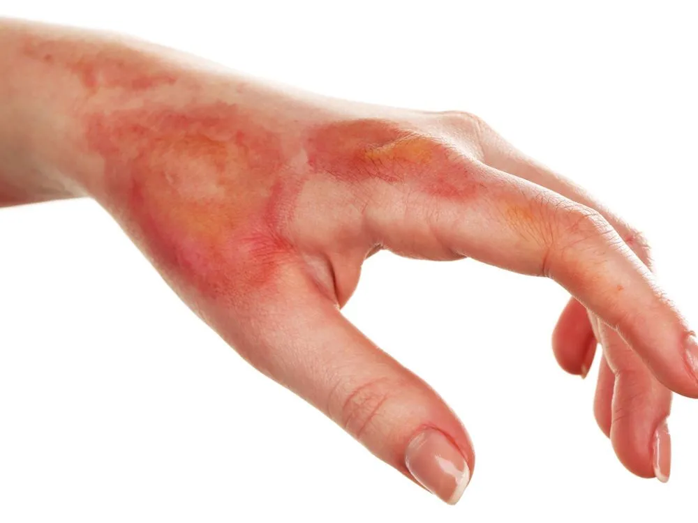 Burn & Reconstructive Surgery